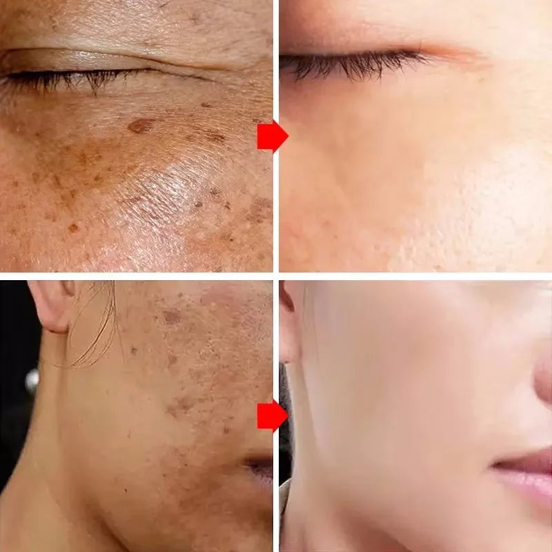 Dark Spots Remover Whitening Serum Face Freckle Melanin Correcting Reduce Fine Lines Brighten Essence Korean Beauty Skin Care - Kellylooks Shop