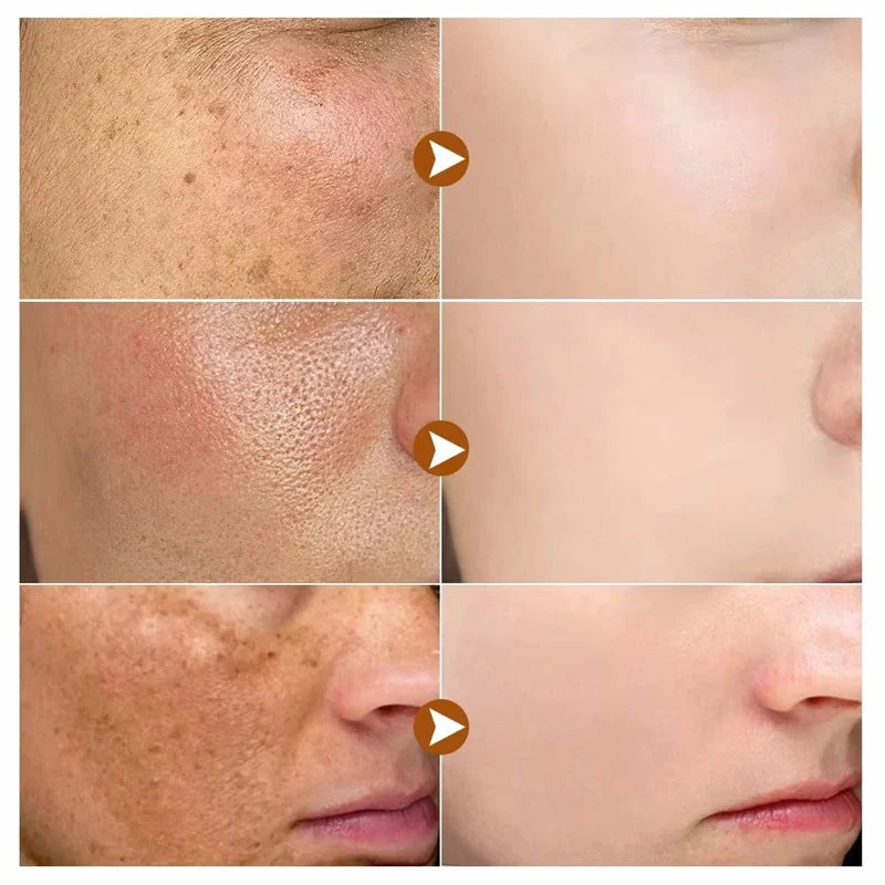 Dark Spots Remover Whitening Serum Face Freckle Melanin Correcting Reduce Fine Lines Brighten Essence Korean Beauty Skin Care - Kellylooks Shop